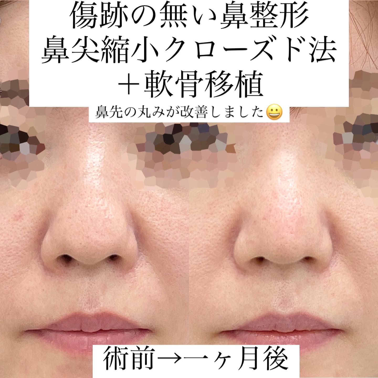 鼻先丸い | 鼻の先を尖らせる – VISHUJI